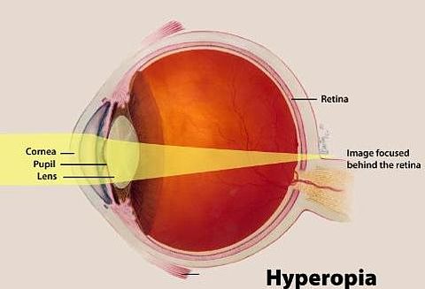 plus hipermetropie literatura de oftalmologie